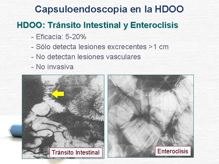 Capsuloendoscopia en la HDOO: Tránsito Intestinal y Enteroclisis - Eficacia: 5 -20% - Sólo