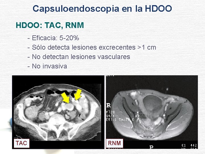 Capsuloendoscopia en la HDOO: TAC, RNM - Eficacia: 5 -20% - Sólo detecta lesiones