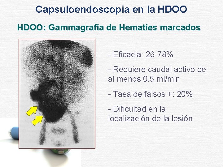 Capsuloendoscopia en la HDOO: Gammagrafía de Hematíes marcados - Eficacia: 26 -78% - Requiere