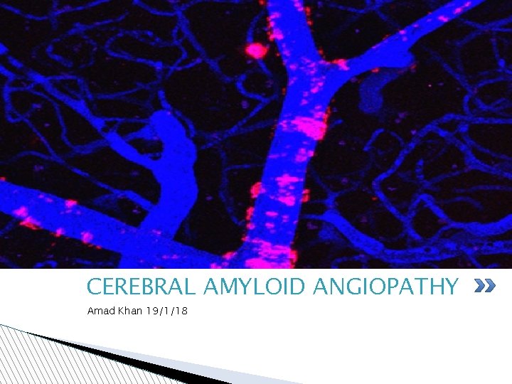 CEREBRAL AMYLOID ANGIOPATHY � Amad Khan 19/1/18 