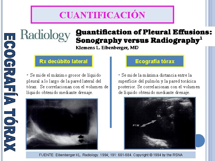 CUANTIFICACIÓN Rx decúbito lateral Ecografía tórax • Se mide el máximo grosor de líquido