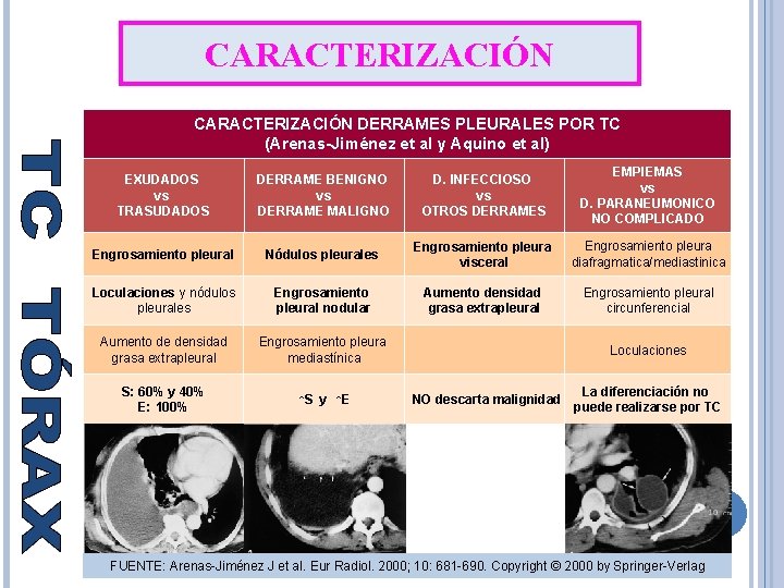 CARACTERIZACIÓN DERRAMES PLEURALES POR TC (Arenas-Jiménez et al y Aquino et al) EXUDADOS vs