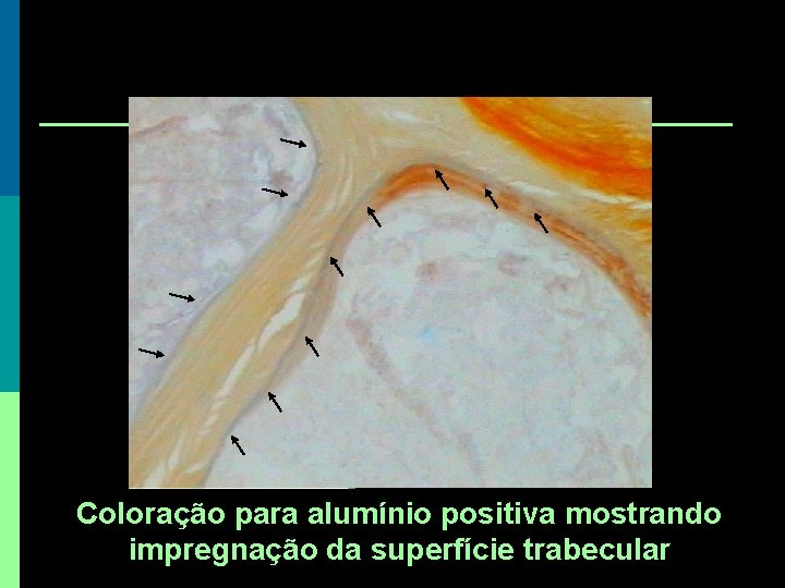 Coloração para alumínio positiva mostrando impregnação da superfície trabecular Coloração para alumínio positiva mostrando impregnação da superfície trabecular