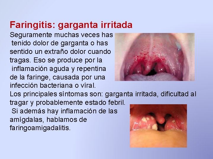 Faringitis: garganta irritada Seguramente muchas veces has tenido dolor de garganta o has sentido Faringitis: garganta irritada Seguramente muchas veces has tenido dolor de garganta o has sentido