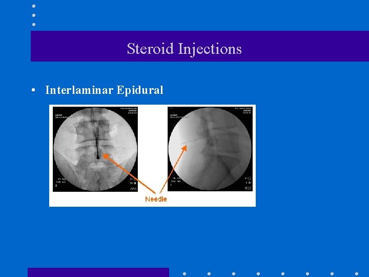 Steroid Injections • Interlaminar Epidural 