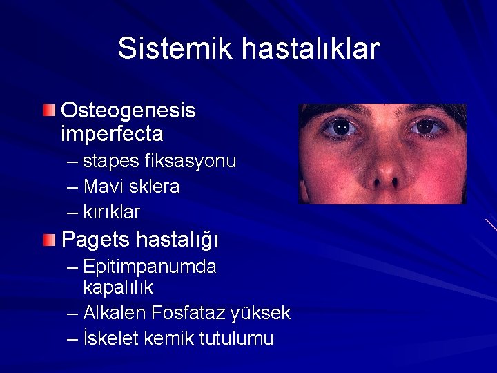 Sistemik hastalıklar Osteogenesis imperfecta – stapes fiksasyonu – Mavi sklera – kırıklar Pagets hastalığı