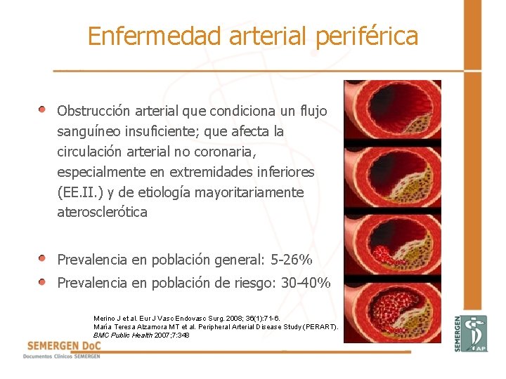 Enfermedad arterial periférica • Obstrucción arterial que condiciona un flujo sanguíneo insuficiente; que afecta