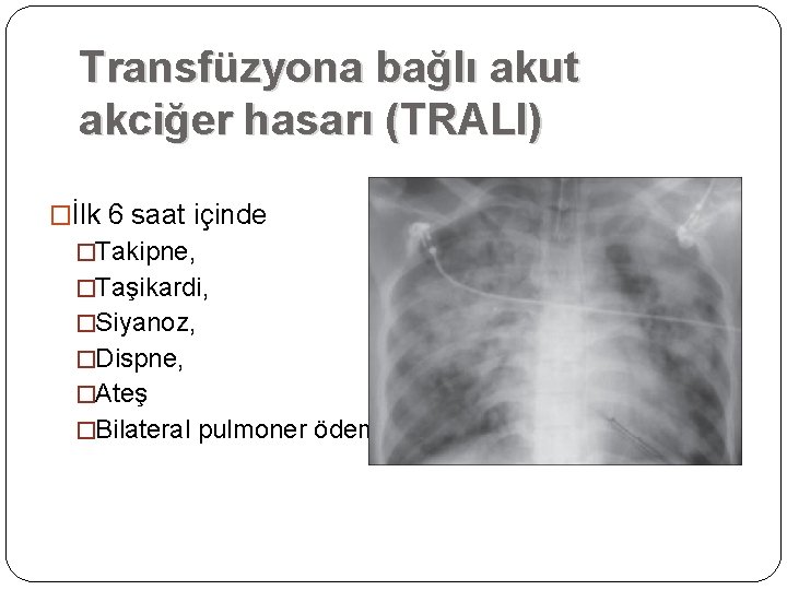 Transfüzyona bağlı akut akciğer hasarı (TRALI) �İlk 6 saat içinde �Takipne, �Taşikardi, �Siyanoz, �Dispne, Transfüzyona bağlı akut akciğer hasarı (TRALI) �İlk 6 saat içinde �Takipne, �Taşikardi, �Siyanoz, �Dispne,