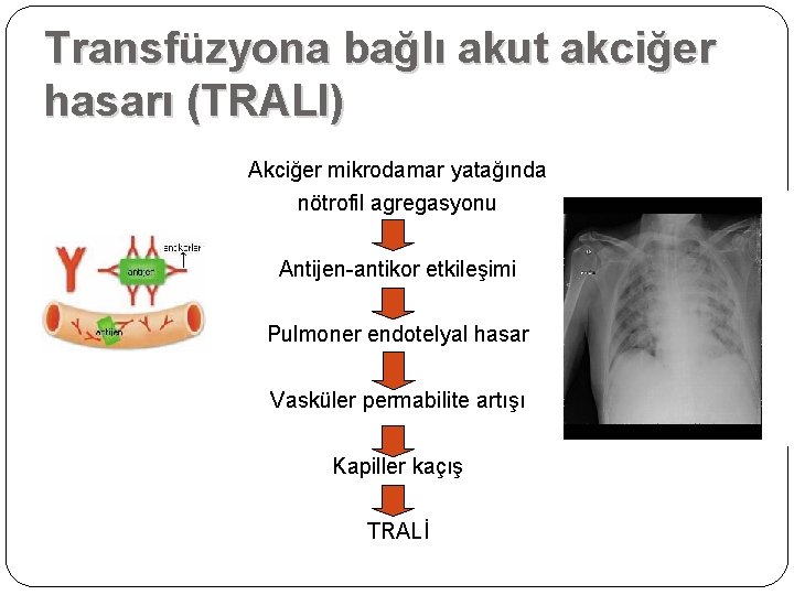 Transfüzyona bağlı akut akciğer hasarı (TRALI) Akciğer mikrodamar yatağında nötrofil agregasyonu Antijen-antikor etkileşimi Pulmoner Transfüzyona bağlı akut akciğer hasarı (TRALI) Akciğer mikrodamar yatağında nötrofil agregasyonu Antijen-antikor etkileşimi Pulmoner