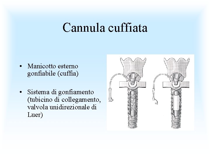 Cannula cuffiata • Manicotto esterno gonfiabile (cuffia) • Sistema di gonfiamento (tubicino di collegamento,