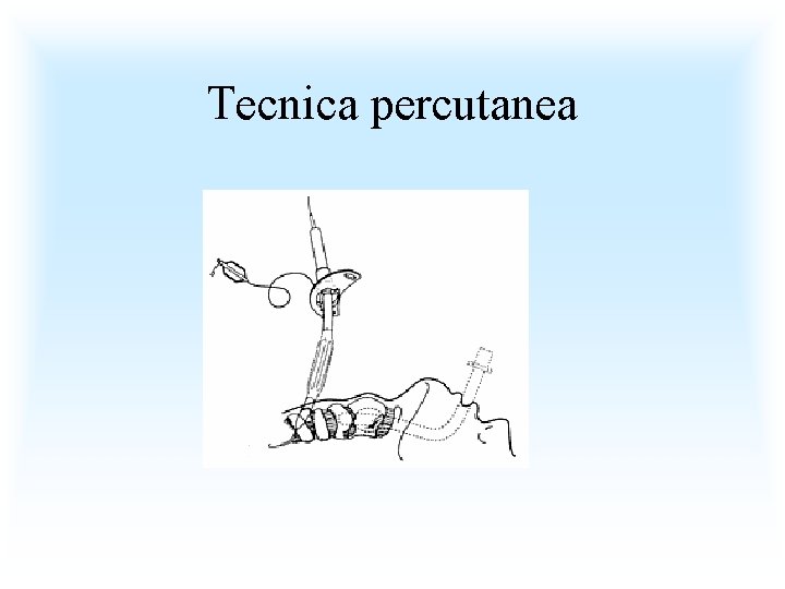 Tecnica percutanea 