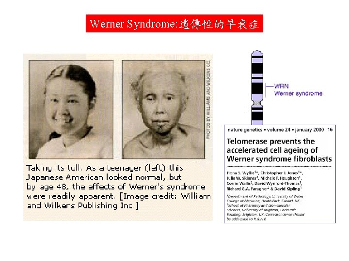 Werner Syndrome: 遺傳性的早衰症 