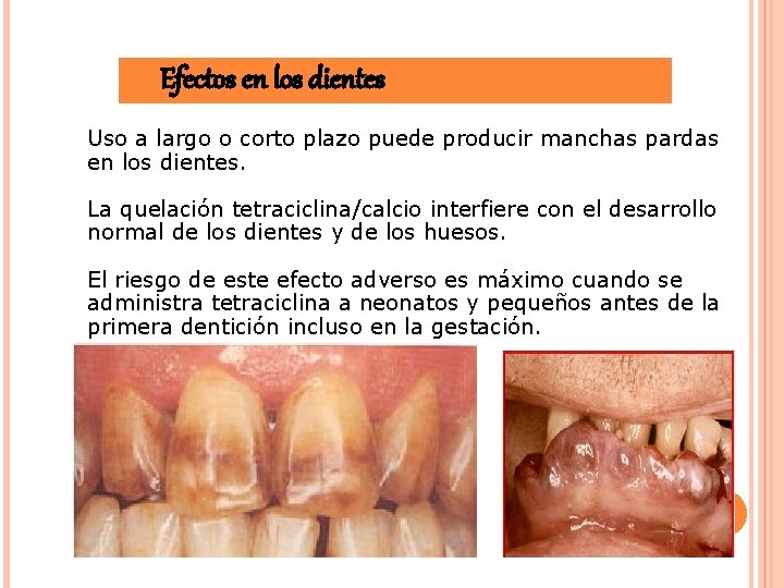 Efectos en los dientes Uso a largo o corto plazo puede producir manchas pardas