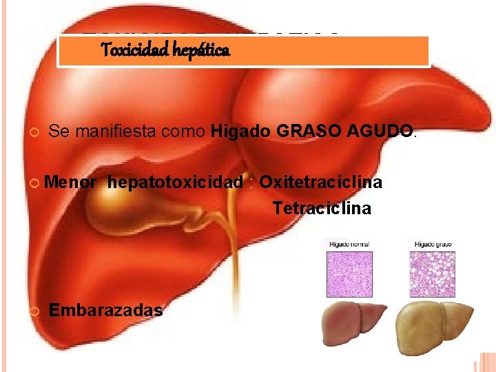 TOXICIDAD Toxicidad hepática. HEPATICA Se manifiesta como Higado GRASO AGUDO. Menor hepatotoxicidad : Oxitetraciclina
