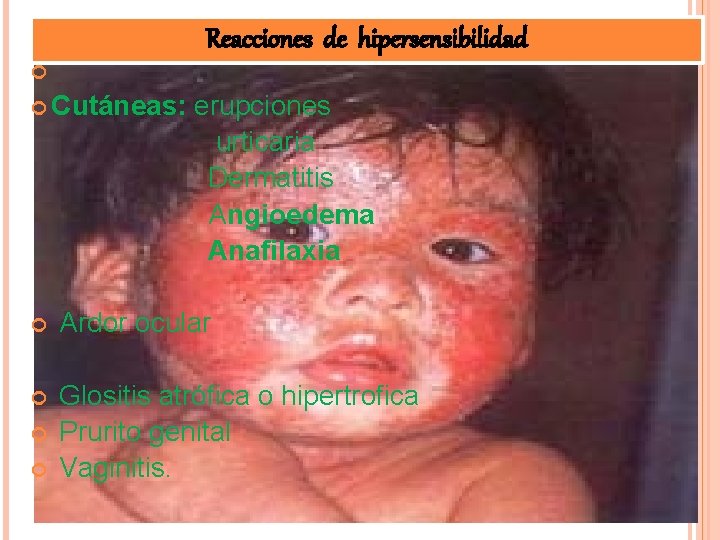 Reacciones de hipersensibilidad Cutáneas: erupciones urticaria Dermatitis Angioedema Anafilaxia Ardor ocular Glositis atrófica o