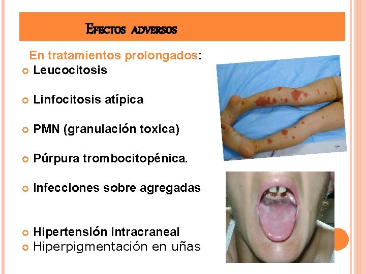 EFECTOS ADVERSOS En tratamientos prolongados: Leucocitosis Linfocitosis atípica PMN (granulación toxica) Púrpura trombocitopénica. Infecciones