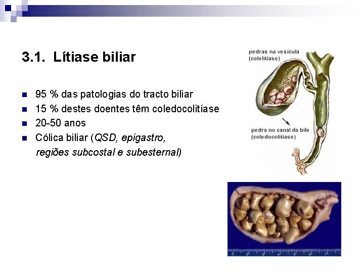 3. 1. Lítiase biliar n n 95 % das patologias do tracto biliar 15