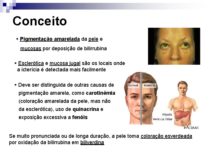 Conceito § Pigmentação amarelada da pele e mucosas por deposição de bilirrubina § Esclerótica