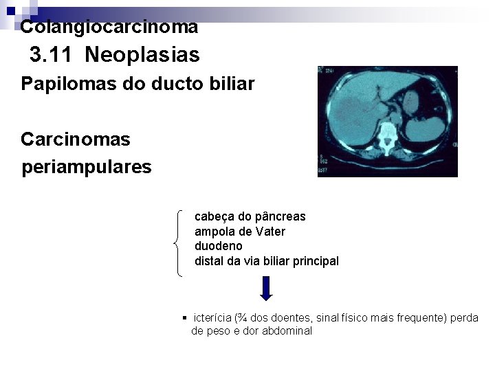 Colangiocarcinoma 3. 11 Neoplasias Papilomas do ducto biliar Carcinomas periampulares cabeça do pâncreas ampola