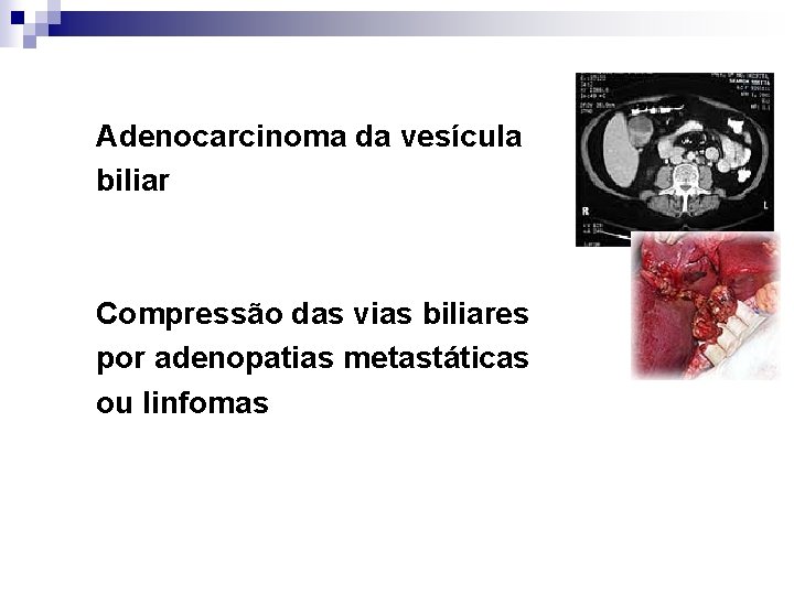 Adenocarcinoma da vesícula biliar Compressão das vias biliares por adenopatias metastáticas ou linfomas 