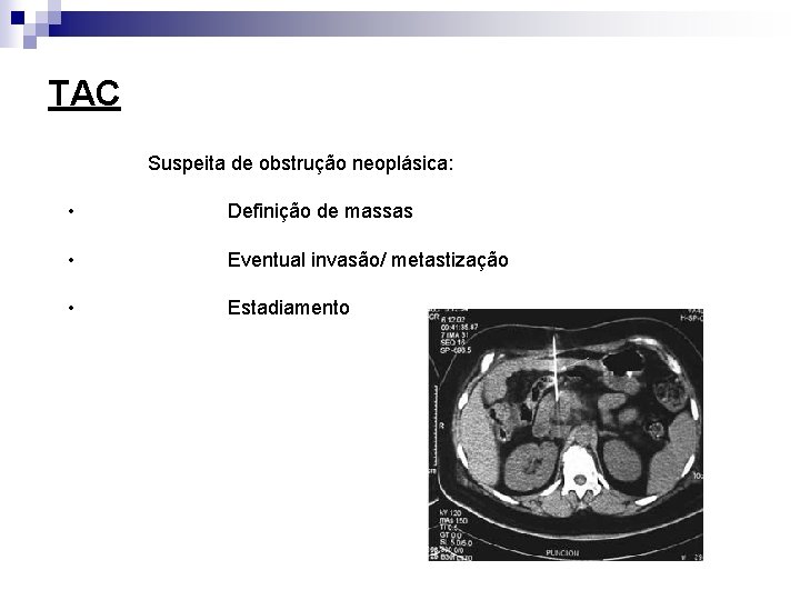 TAC Suspeita de obstrução neoplásica: • Definição de massas • Eventual invasão/ metastização •