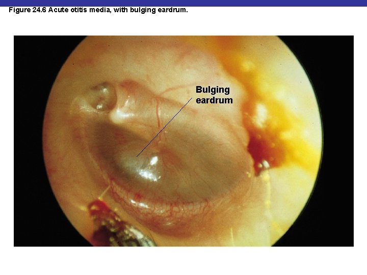 Figure 24. 6 Acute otitis media, with bulging eardrum. Bulging eardrum 