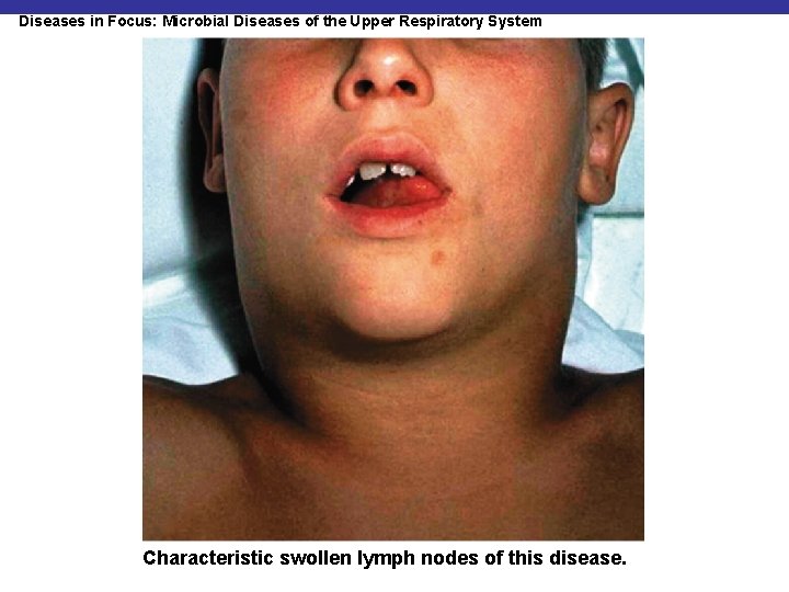 Diseases in Focus: Microbial Diseases of the Upper Respiratory System Characteristic swollen lymph nodes