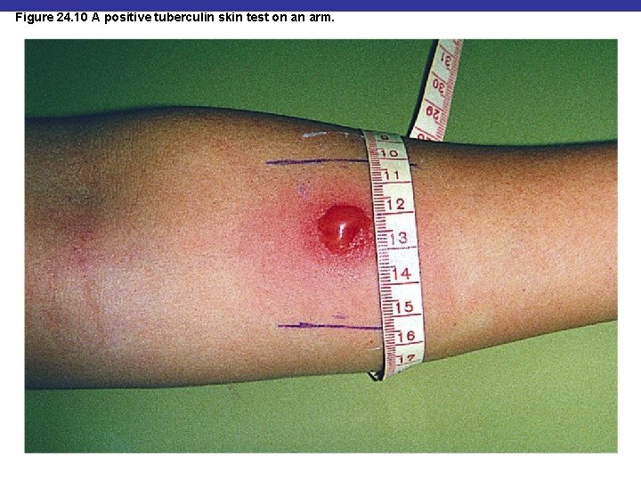 Figure 24. 10 A positive tuberculin skin test on an arm. 