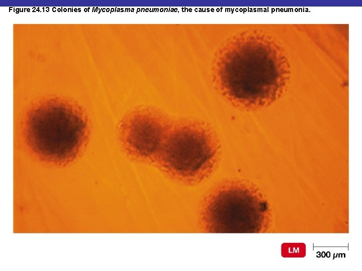 Figure 24. 13 Colonies of Mycoplasma pneumoniae, the cause of mycoplasmal pneumonia. 