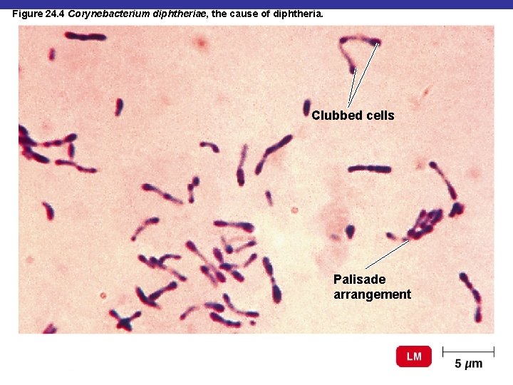 Figure 24. 4 Corynebacterium diphtheriae, the cause of diphtheria. Clubbed cells Palisade arrangement 