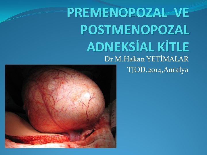 PREMENOPOZAL VE POSTMENOPOZAL ADNEKSİAL KİTLE Dr. M. Hakan YETİMALAR TJOD, 2014, Antalya 