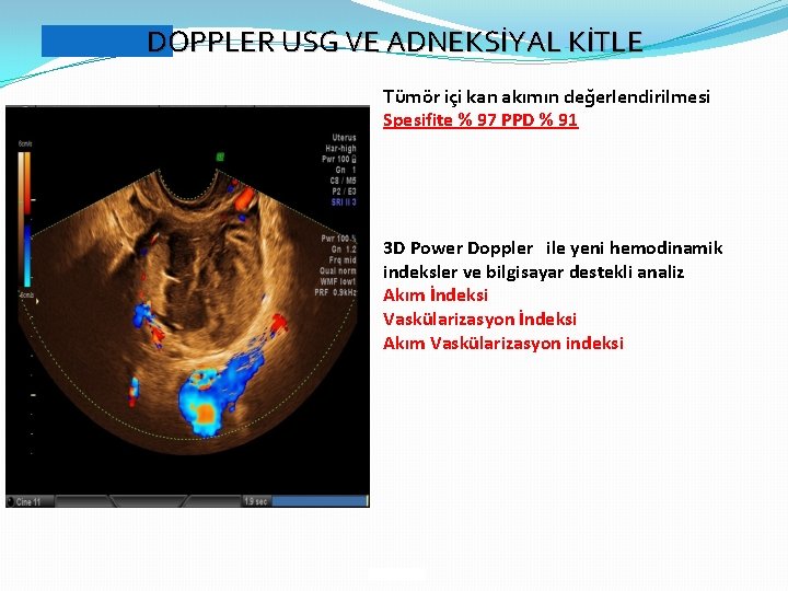 DOPPLER USG VE ADNEKSİYAL KİTLE Tümör içi kan akımın değerlendirilmesi Spesifite % 97 PPD