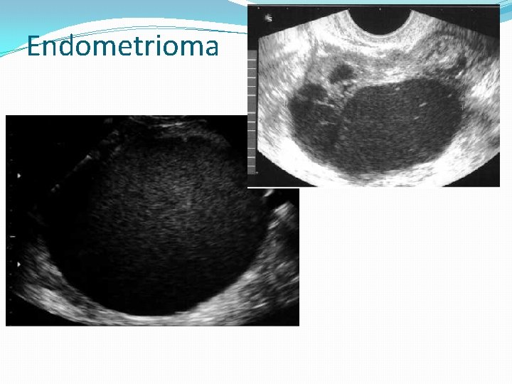 Endometrioma 