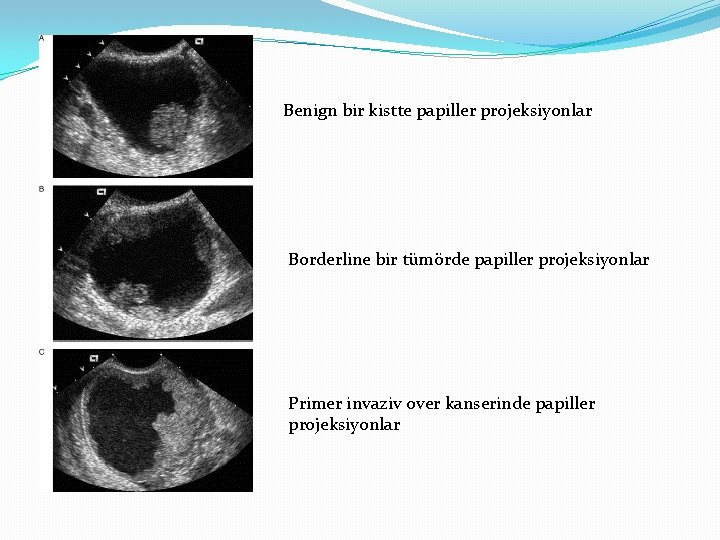Benign bir kistte papiller projeksiyonlar Borderline bir tümörde papiller projeksiyonlar Primer invaziv over kanserinde