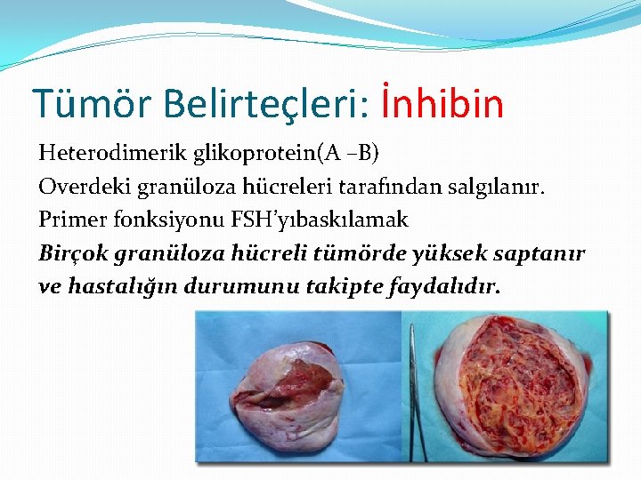 Tümör Belirteçleri: İnhibin Heterodimerik glikoprotein(A –B) Overdeki granüloza hücreleri tarafından salgılanır. Primer fonksiyonu FSH’yıbaskılamak