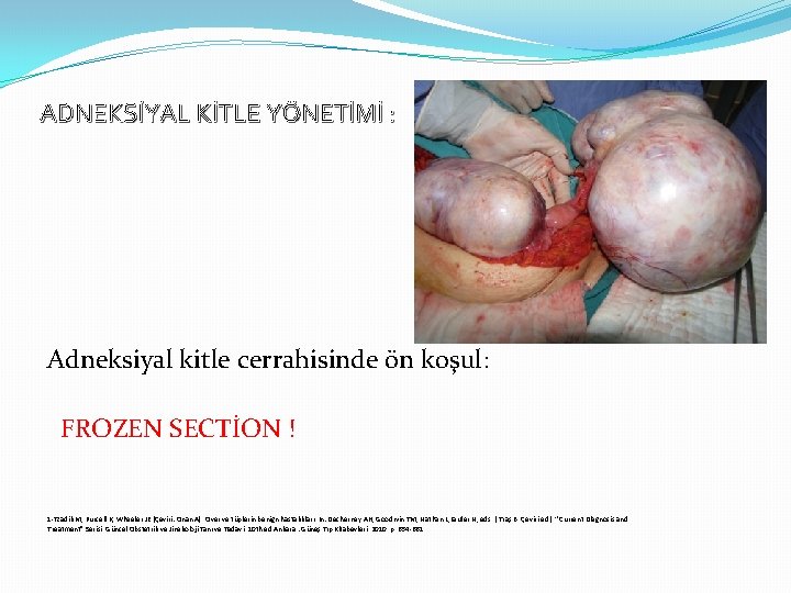 ADNEKSİYAL KİTLE YÖNETİMİ : Adneksiyal kitle cerrahisinde ön koşul: FROZEN SECTİON ! 1 -Tzadik