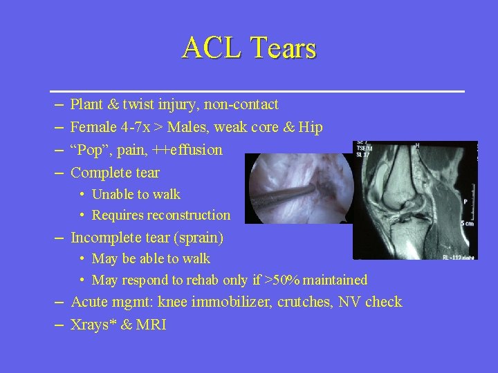 ACL Tears – – Plant & twist injury, non-contact Female 4 -7 x >