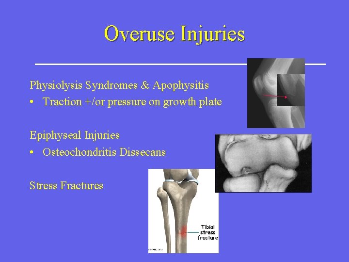 Overuse Injuries Physiolysis Syndromes & Apophysitis • Traction +/or pressure on growth plate Epiphyseal