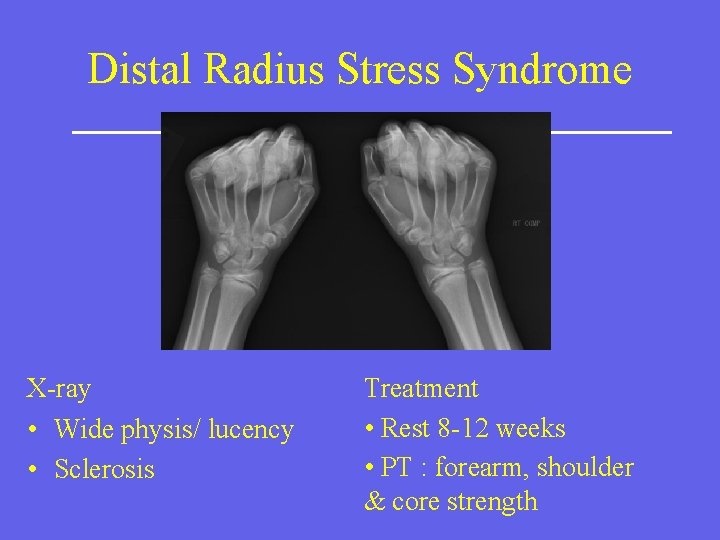 Distal Radius Stress Syndrome X-ray • Wide physis/ lucency • Sclerosis Treatment • Rest