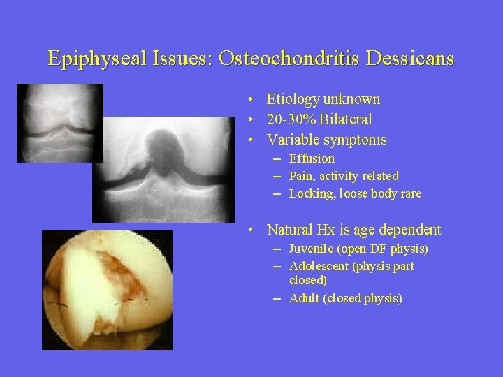 Epiphyseal Issues: Osteochondritis Dessicans • Etiology unknown • 20 -30% Bilateral • Variable symptoms