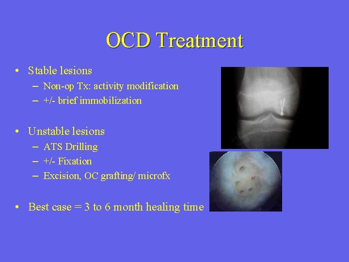 OCD Treatment • Stable lesions – Non-op Tx: activity modification – +/- brief immobilization