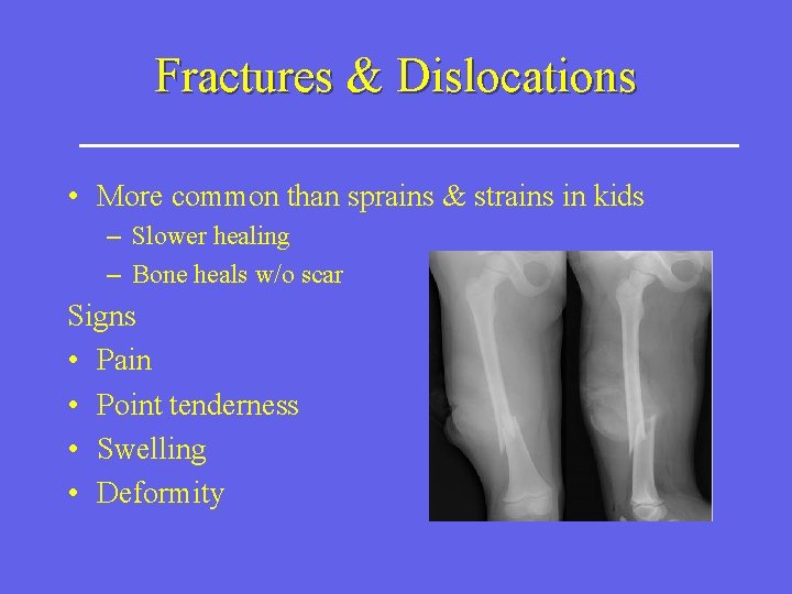 Fractures & Dislocations • More common than sprains & strains in kids – Slower