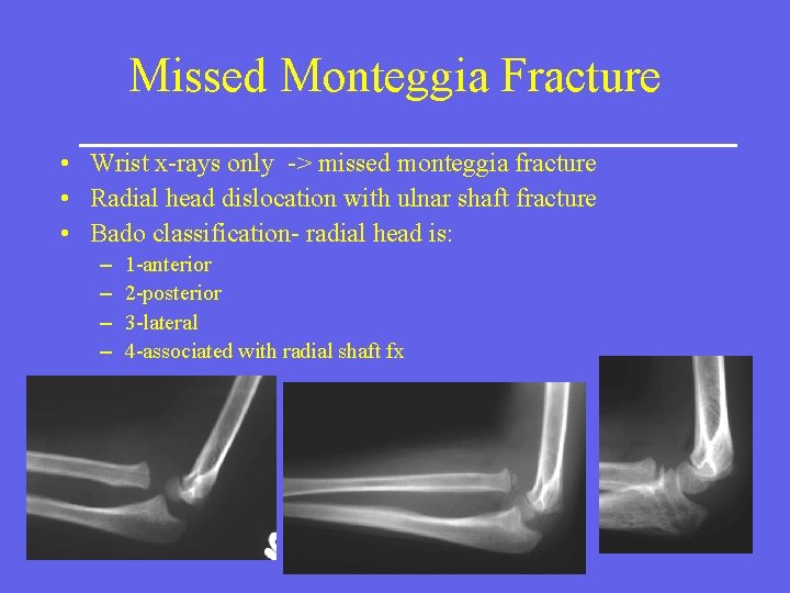 Missed Monteggia Fracture • Wrist x-rays only -> missed monteggia fracture • Radial head