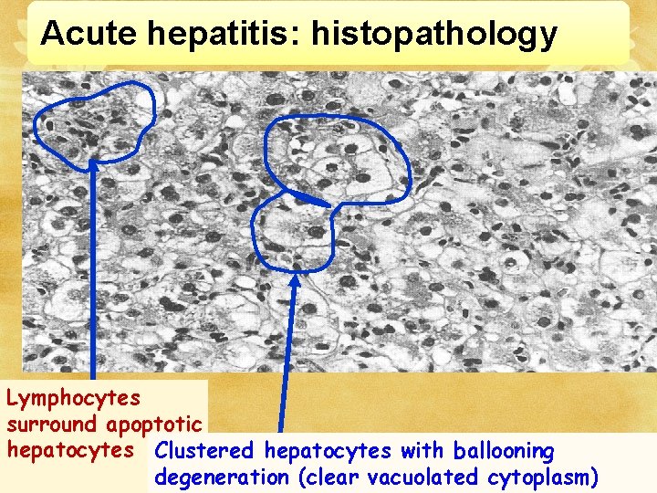 Acute hepatitis: histopathology Lymphocytes surround apoptotic hepatocytes Clustered hepatocytes with ballooning degeneration (clear vacuolated