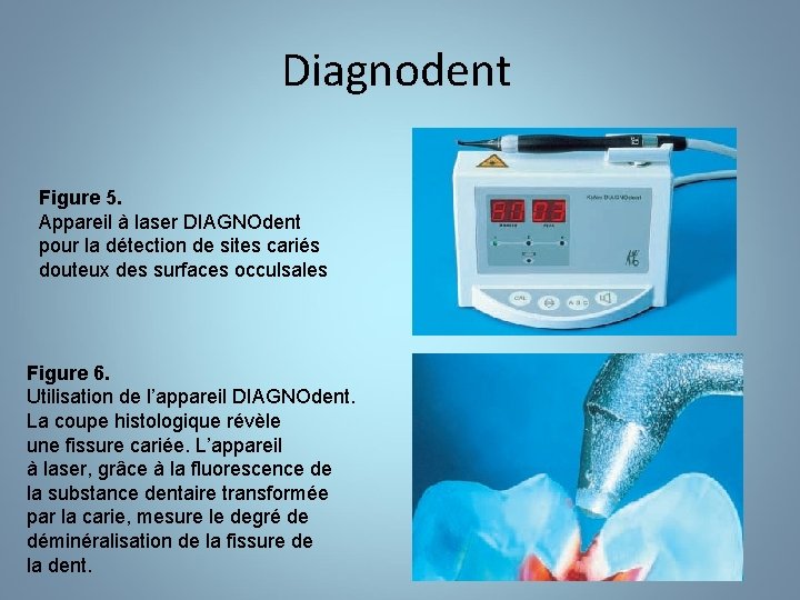 Diagnodent Figure 5. Appareil à laser DIAGNOdent pour la détection de sites cariés douteux