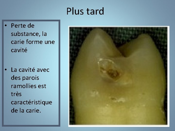 Plus tard • Perte de substance, la carie forme une cavité • La cavité