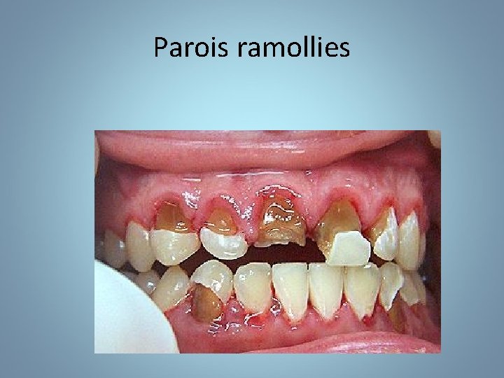 Parois ramollies 