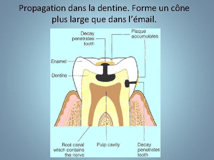 Propagation dans la dentine. Forme un cône plus large que dans l’émail. 