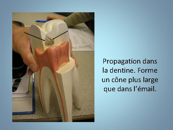 Propagation dans la dentine. Forme un cône plus large que dans l’émail. 
