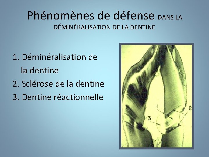 Phénomènes de défense DANS LA DÉMINÉRALISATION DE LA DENTINE 1. Déminéralisation de la dentine